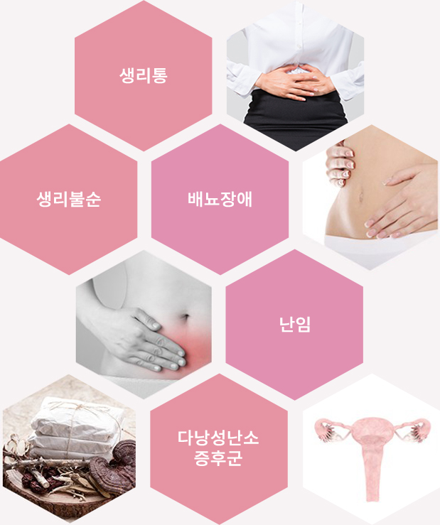 생리통, 생리불순, 배뇨장애, 난임, 다낭성난소 증후군